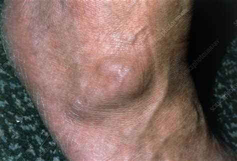 View Of A Ganglion Found On The Foot Of A Patient Stock Image M165