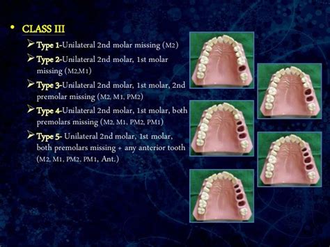 Classification Of Partially Edentulous Arches