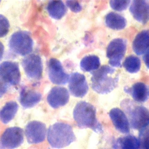 Pleural Fluid Cytology Showing Lymphoblasts Giemsa 1000x Download