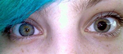 Llamativa Anisocoria Tamaño Distinto De Las Pupilas De Los Ojos