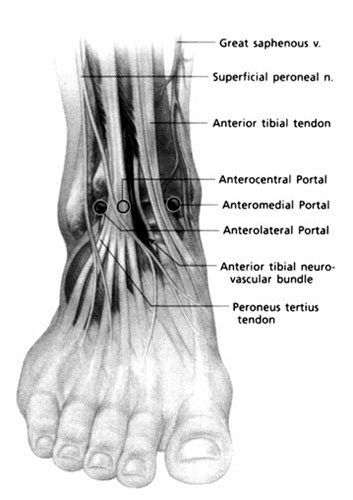 Ankle Arthroscopy Foot And Ankle Orthobullets