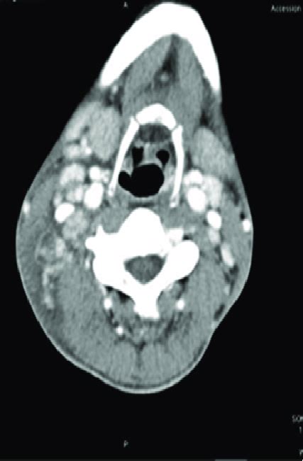 A Ct Scan Of The Neck Showing Multiple Enlarged Necrotic Lymph Nodes On