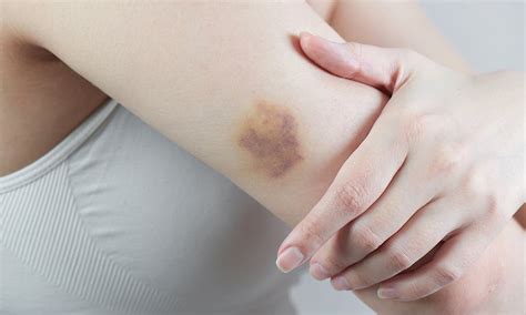 What It Means If You Bruise Easily Newbeauty