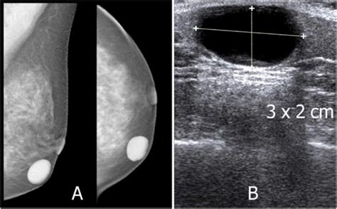 Overview Of Epidermoid Cyst European Journal Of Radiology Open