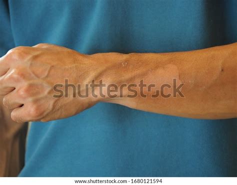 Peeling Skin Arm Sunburn Effect Stock Photo 1680121594 Shutterstock