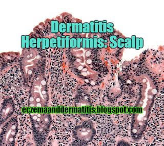 Dermatitis Herpetiformis Scalp Eczema And Dermatitis