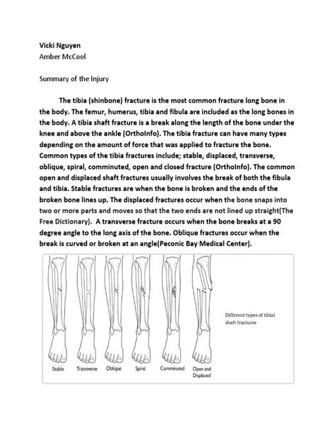 paul george 2f tibia-fibula fracture | Knee | Ankle