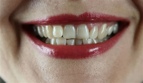 White Spots On Teeth Adults Archives Diseases Data