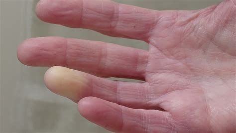 Raynauds Syndrome Explained Causes Symptoms And Treatments