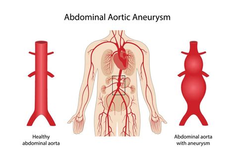 Abdominal Aortic Aneurysm In El Paso Tx