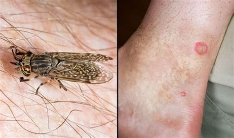 Are Horsefly Bites Dangerous The 5 Signs Youve Been Bitten Express