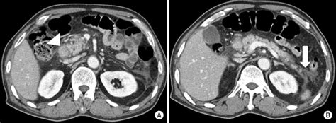 Abdominal Computed Tomography A B Showed Mild Swelling Of The