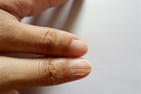 Signs You May Be Anemic | Things Health