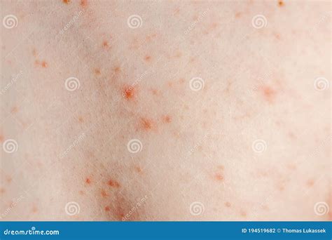 Urticaria Or Hives On The Back On The Shoulder Red Rashes Itchy Bumps