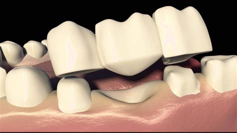 3d Animation Shows The Dental Bridges 3 Unit Bridges Procedure Nyc