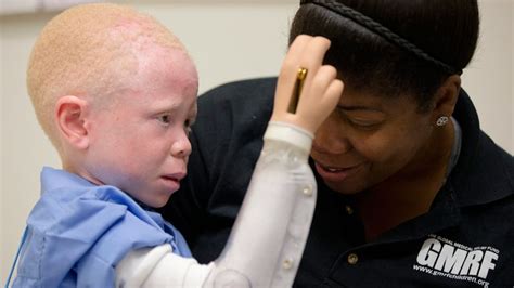 For Africas Hunted Albino Children Us Charity Offers True Hope