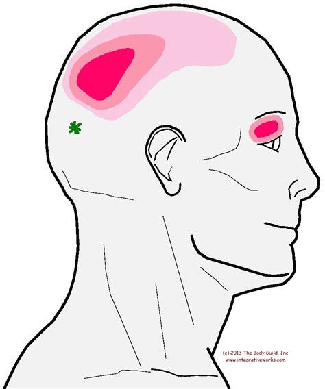 Headache Beside Crown With Achy Eye Pain Integrative Works