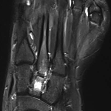 Sagital Mri Left Foot Demonstrating Cuneiform Stress Fracture