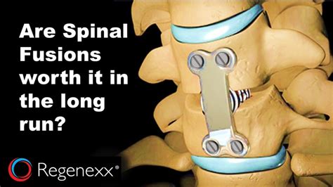 Spinal Fusion Is It Worth It
