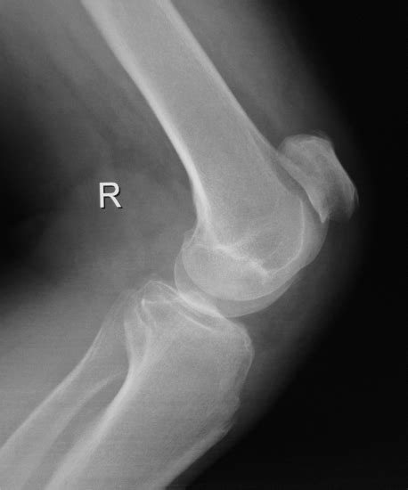 Lateral Knee Radiograph