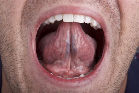 Hpv Under Tongue Tot Ce Trebuie Sa Stii Despre Hpv Simptome Tratament