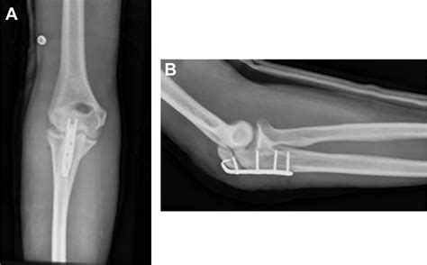 Surgical Treatment Of Displaced Olecranon Fracture Through A Persistent