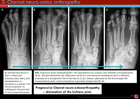 Figure 3 From Charcot Foot And Osteomyelitis In Diabetes Radiologist