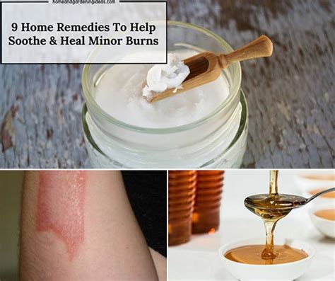 9 Home Remedies To Help Soothe And Heal Minor Burns