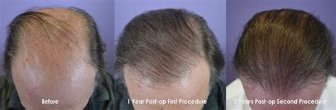 Procedure Fut Hair Transplant On A Year Old Male Hair