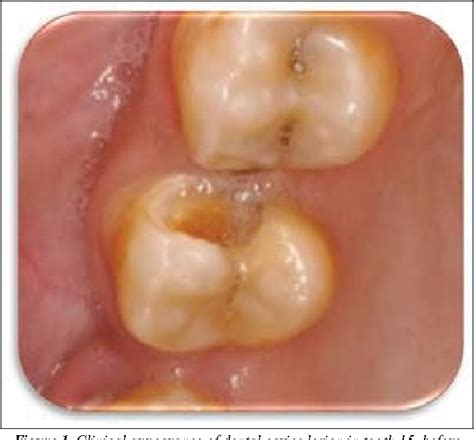 Figure 1 From Stepwise Excavation A Conservative Community Based Dental