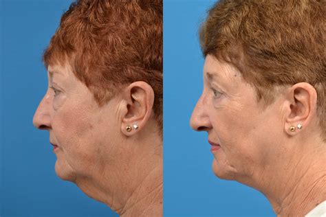 Profile Neck Lift Photos Melbourne Fl Patient 15057