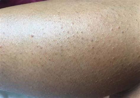 Ingrown Leg Hair Infected Removal Treatments Strong Hair