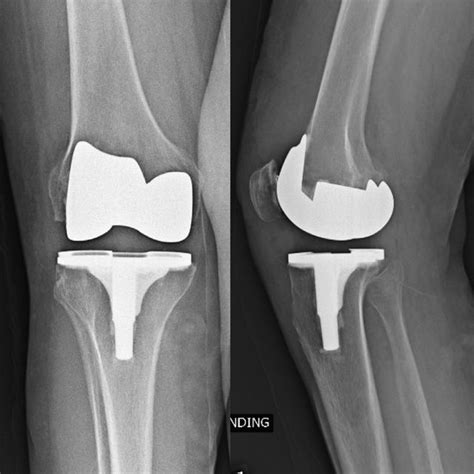 Postoperative Radiographs Ap And Lateral Views Of The Right Knee After
