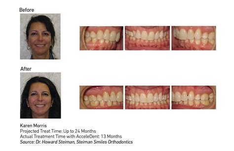 Created by attaching strong wires to small metal brackets braces apply constant pressure to your. Open Bite, Over Bite and TMJ Patients Choose AcceleDent ...