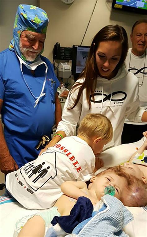 Conjoined Twins Finally Separated After 16 Hour Surgery