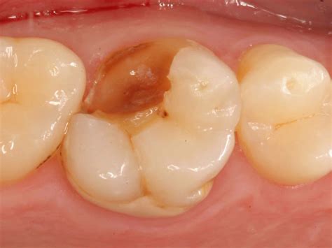 Tooth Broke When Biting Bellevue Dentist Dr Peter Chien