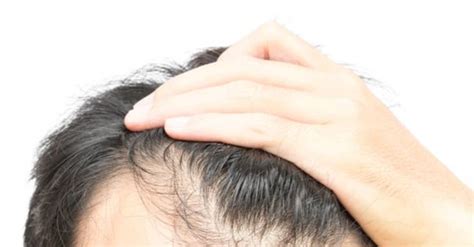 How To Regrow Hair On Bald Patches The 4 Best Non Surgical Treatments