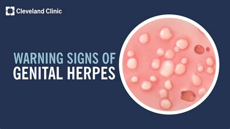 Warning Signs Of Genital Herpes Youtube