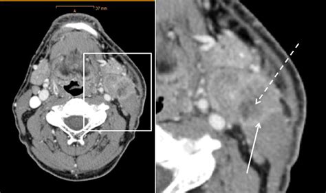 Radiological Detection Of Extracapsular Spread In Head And Neck