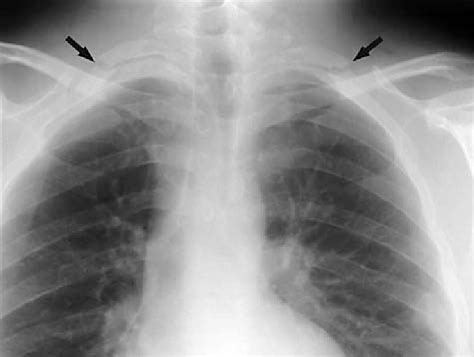 Chest X Ray Showing Bilateral First Rib Fracture With N Open I Hot