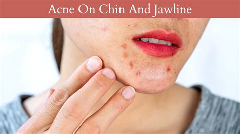Acne On Chin And Jawline Its Causes And Treatments The Skincare Web