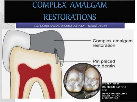 Complex Amalgam Restoration Ppt