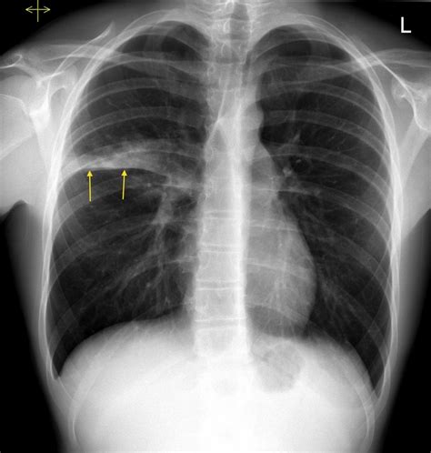 Chest X Ray Showing Left Lower Lobe Consolidation Wit Vrogue Co