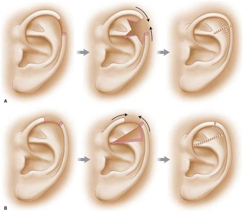 Ear Plastic Surgery Key