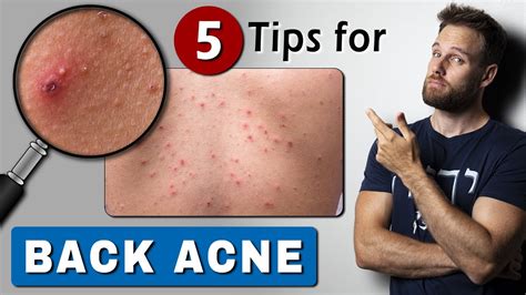 How To Get Rid Of Back Acne Fast And Easy Youtube