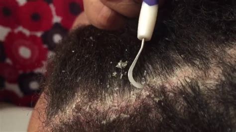 Dandruff Picking And Combing Dry Flaky Scalp Almost Completely Covered
