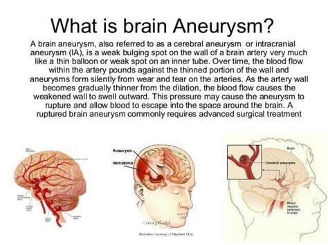 To find out if you have a brain aneurysm, your healthcare provider will order an imaging. What is an aneurysm ? | Brain aneurysm, Aneurysm, Brain ...