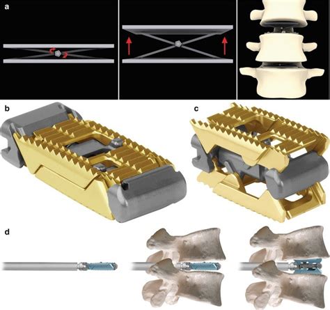 Expandable Cages For Lumbar Spinal Deformity Springerlink
