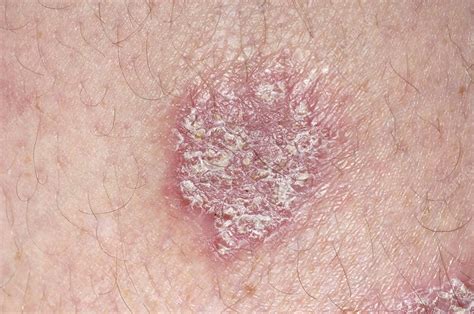 Chronic Plaque Psoriasis Stock Image M2400768 Science Photo Library
