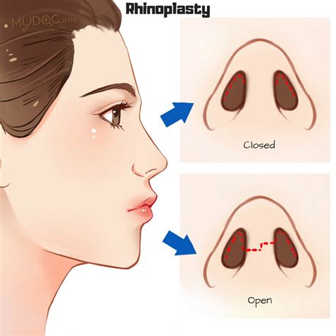What Is Liquid Rhinoplasty Its Procedure And Benefits
